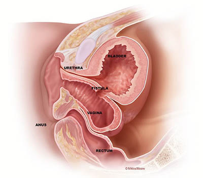 Vesico - vaginal fistula treatment and surgery hospital Ghaziabad